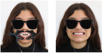 Le Digital Smile Design : de la conception virtuelle au sourire réel — illustration à travers un cas clinique