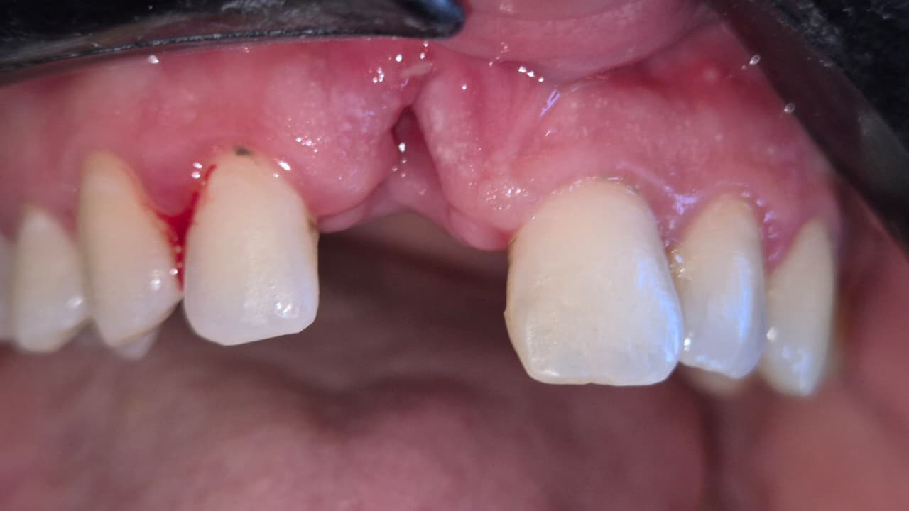 Esthetic Zone Rehabilitation Using Guided Implant Placement and Simultaneous Guided Bone Regeneration: A Case Report